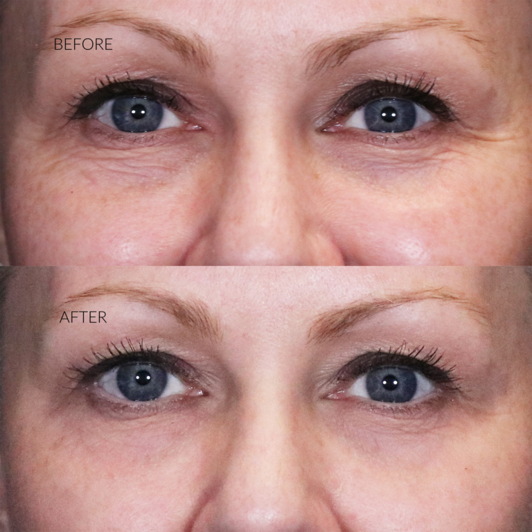 PRP-Undereyes before and after