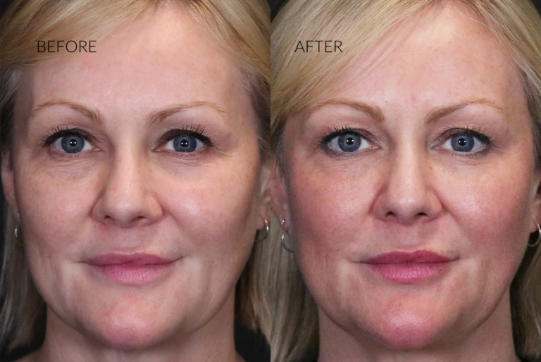 PRP for Under eyes before and after