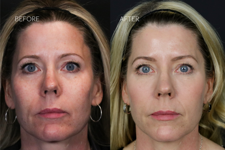 PRP Under eyes before and after