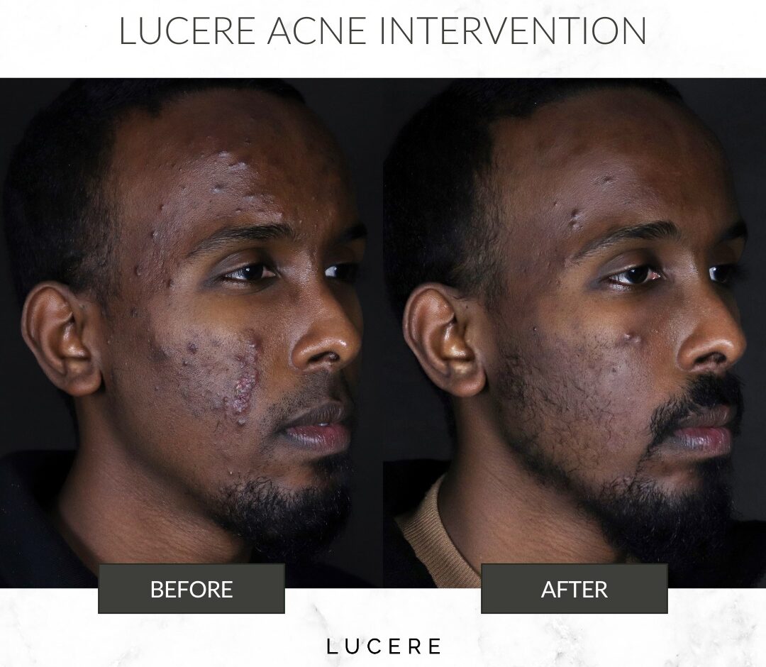 Acne treatment Before and after