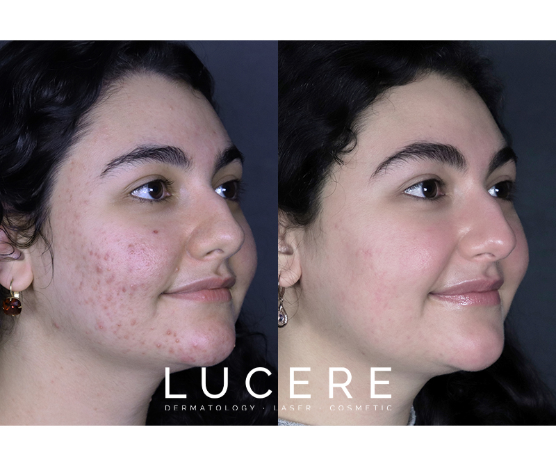 acne before and after