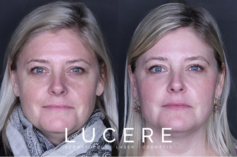 Botox for Hooded eyes