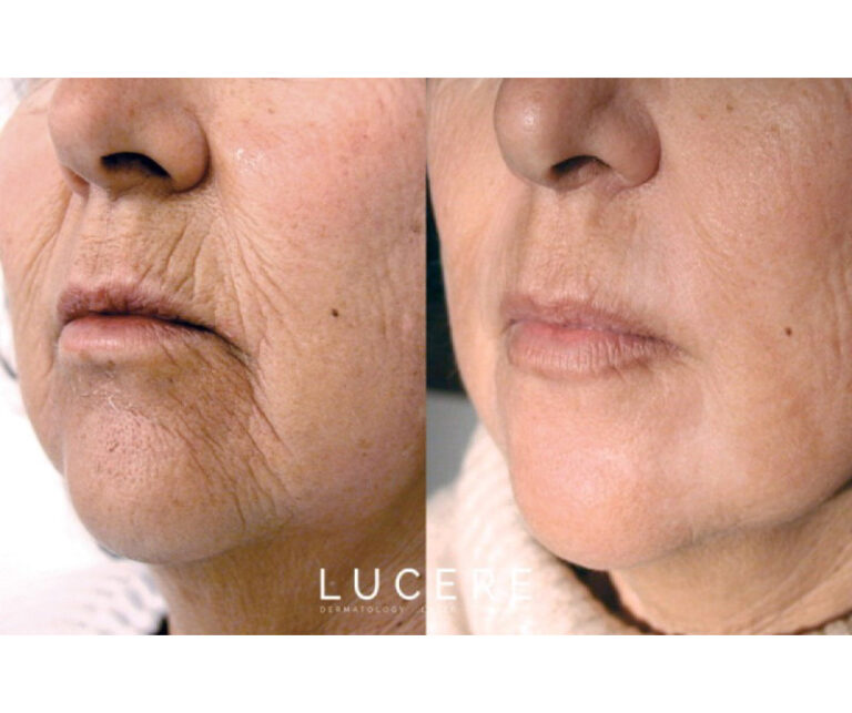 Fotona skin tightening before and after