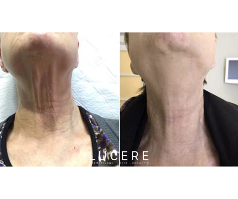 Fotona skin tightening neck before and after