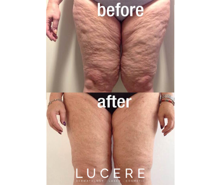 fotona skin tighening in leg before and after