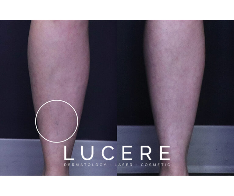 Ultrasound Guided Foam Sclerotherapy Thighs before and after Closeups front right leg marks