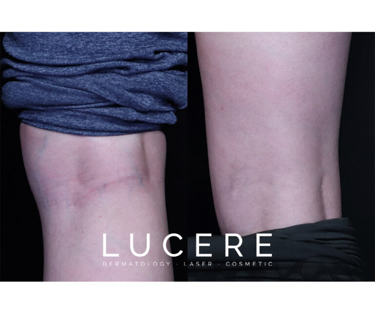 Ultrasound Guided Foam Sclerotherapy before and after
