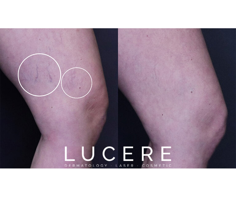 Ultrasound Guided Foam Sclerotherapy before and after thai