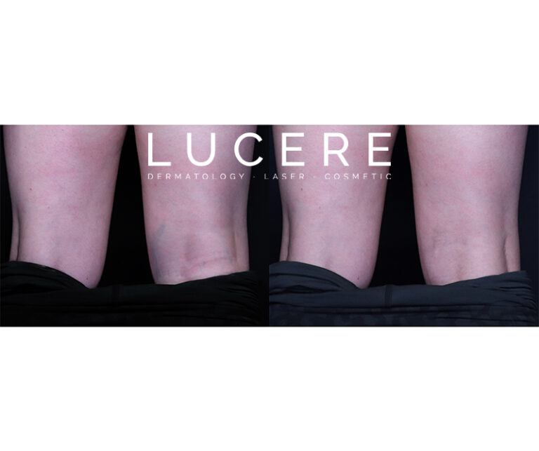 Ultrasound Guided Foam Sclerotherapy leg before and after