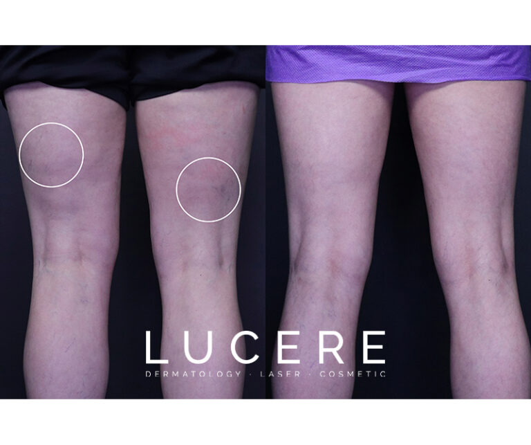 Ultrasound Guided Foam Sclerotherapy near knee before and after