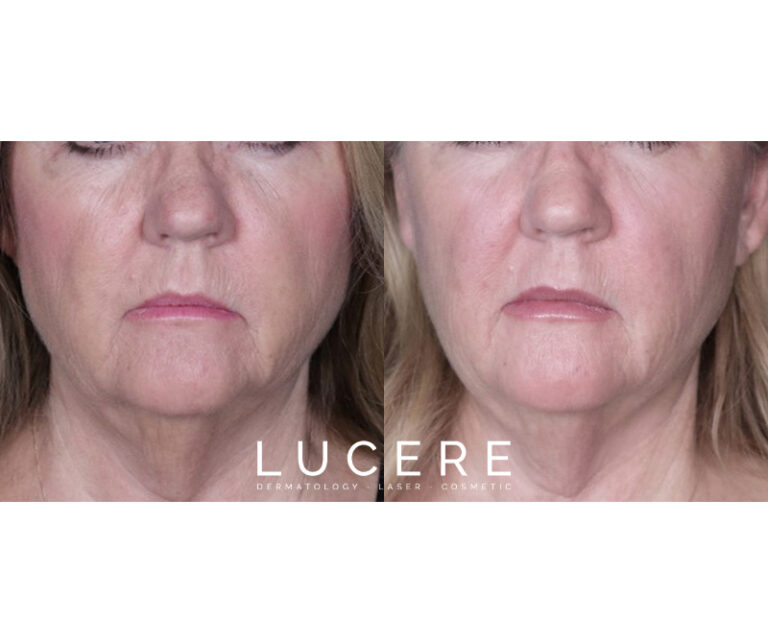 Full Face Botox and Filler before and after