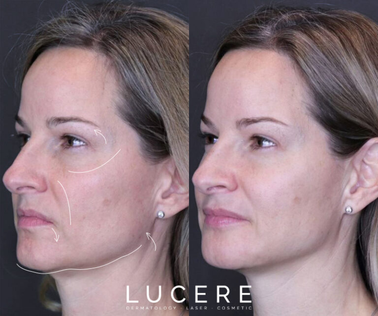 Full Face Botox and Filler before and after left side results
