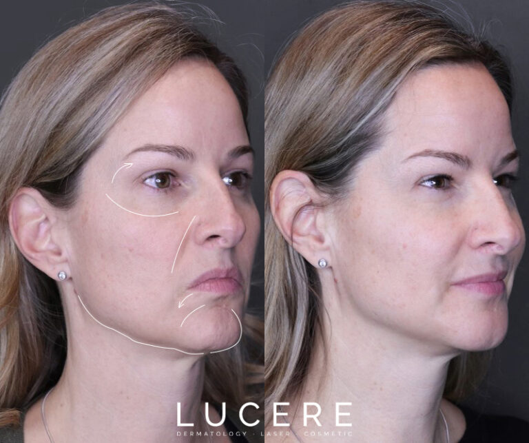 Full Face Botox and Filler before and after results