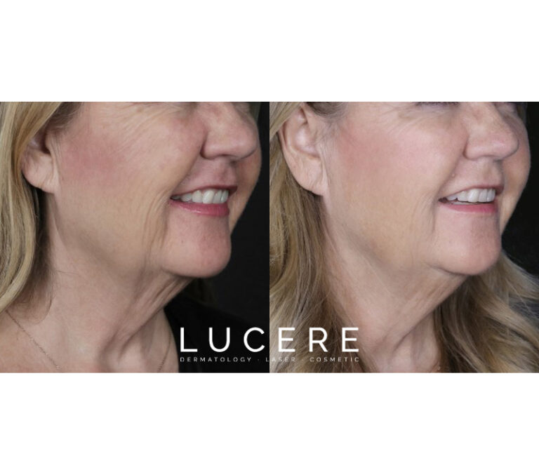 Full Face Botox and Filler before and after results right side