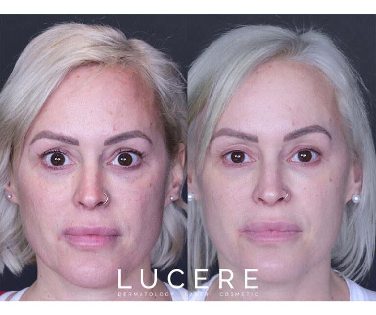 PRP for facial rejuvenation before and after front side