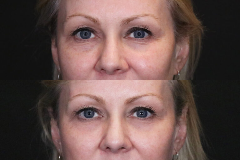 PRP for facial rejuvenation before and after front side results