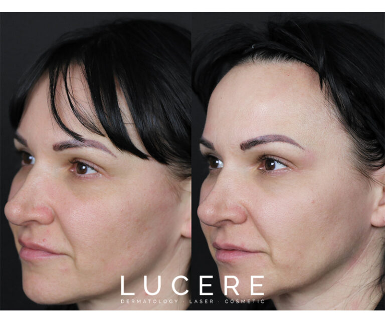 PRP for facial rejuvenation before and after left side