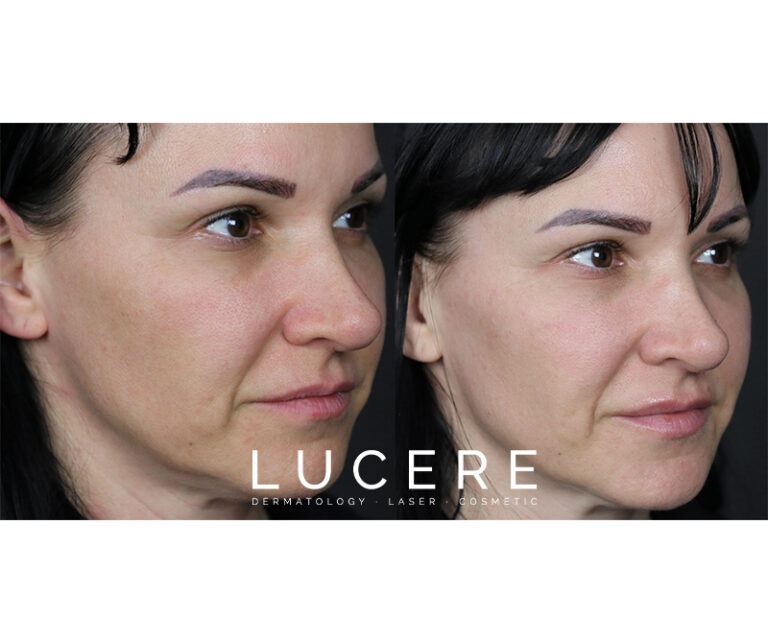 PRP for facial rejuvenation before and after right side results