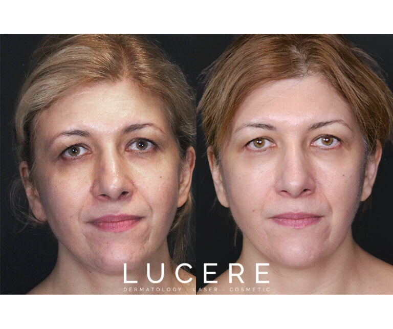 PRP for facial results