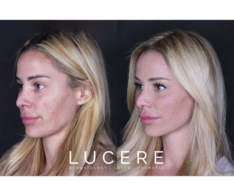 Top model cheeks before and after