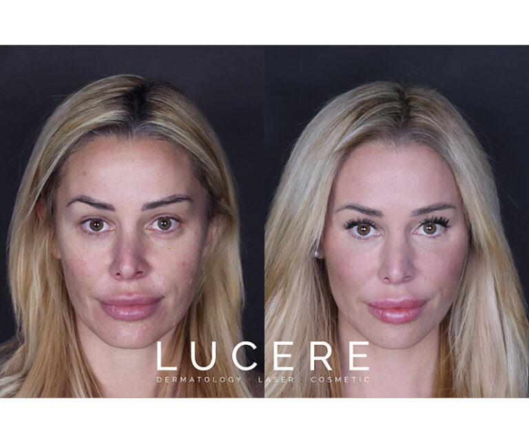 Top model cheeks fillers before and after results
