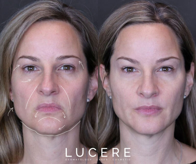 filers treatment at Lucere