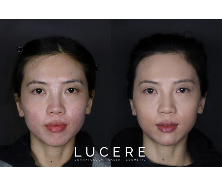 fillers before and after