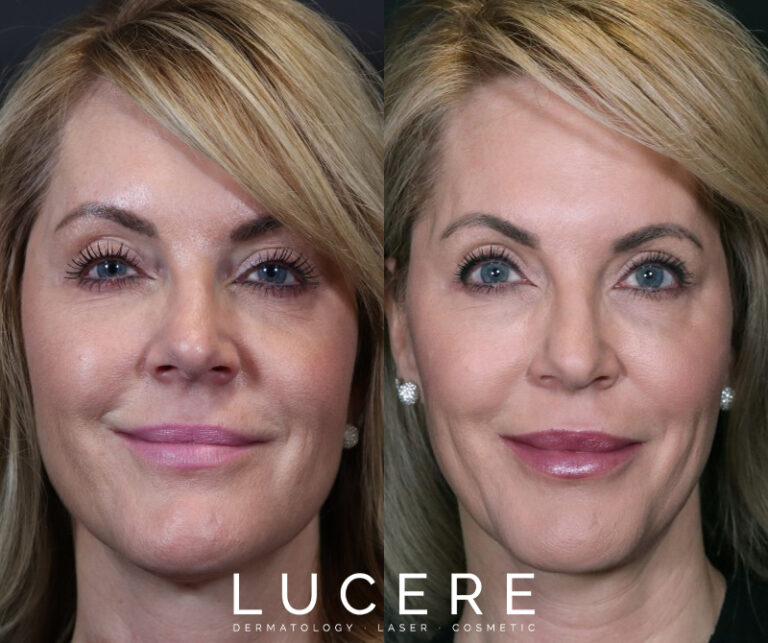 full face results before and after