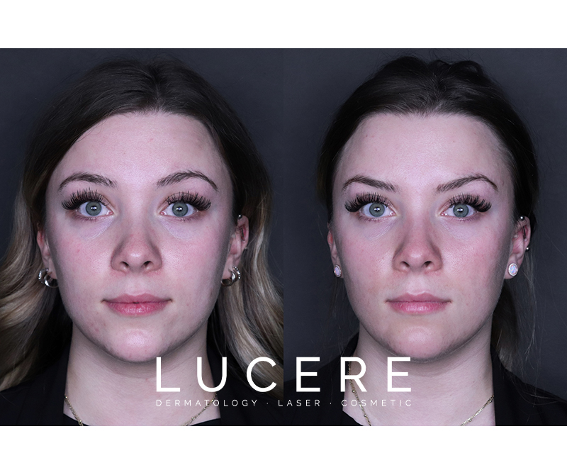 Botox forehead before and after